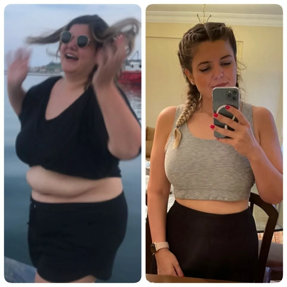 Weight loss surgery before and after transformation - patient 1
