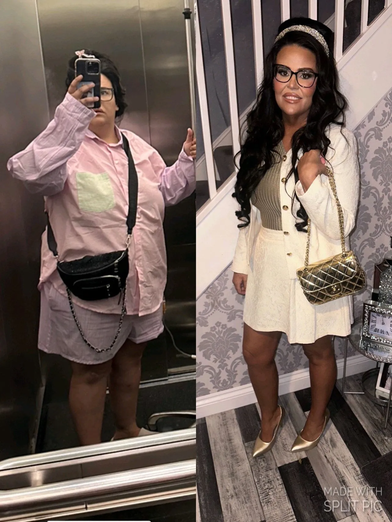 Weight loss surgery before and after transformation - patient 10