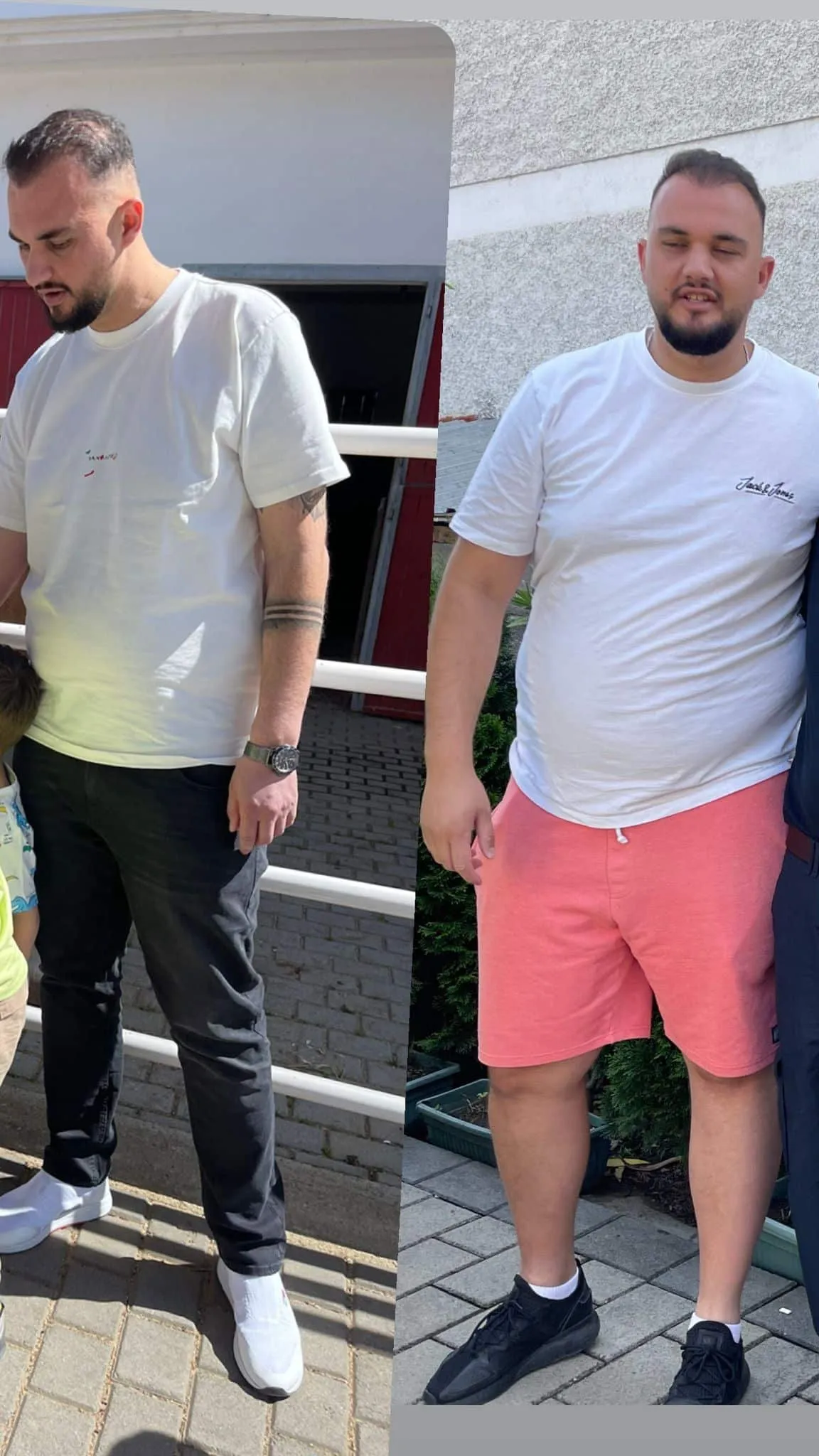 Weight loss surgery before and after transformation - patient 11