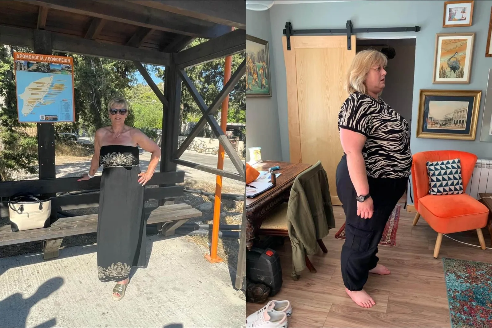 Weight loss surgery before and after transformation - patient 2