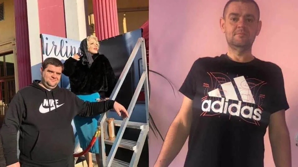 Weight loss surgery before and after transformation - patient 3