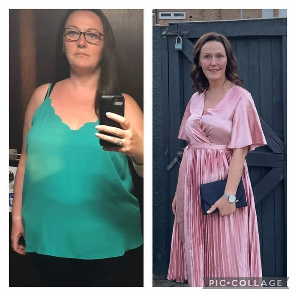 Weight loss surgery before and after transformation - patient 4
