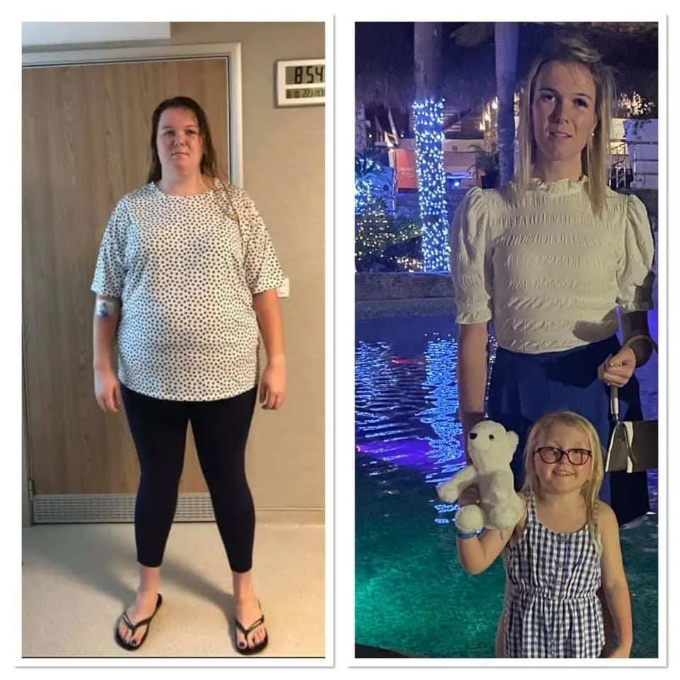 Weight loss surgery before and after transformation - patient 5