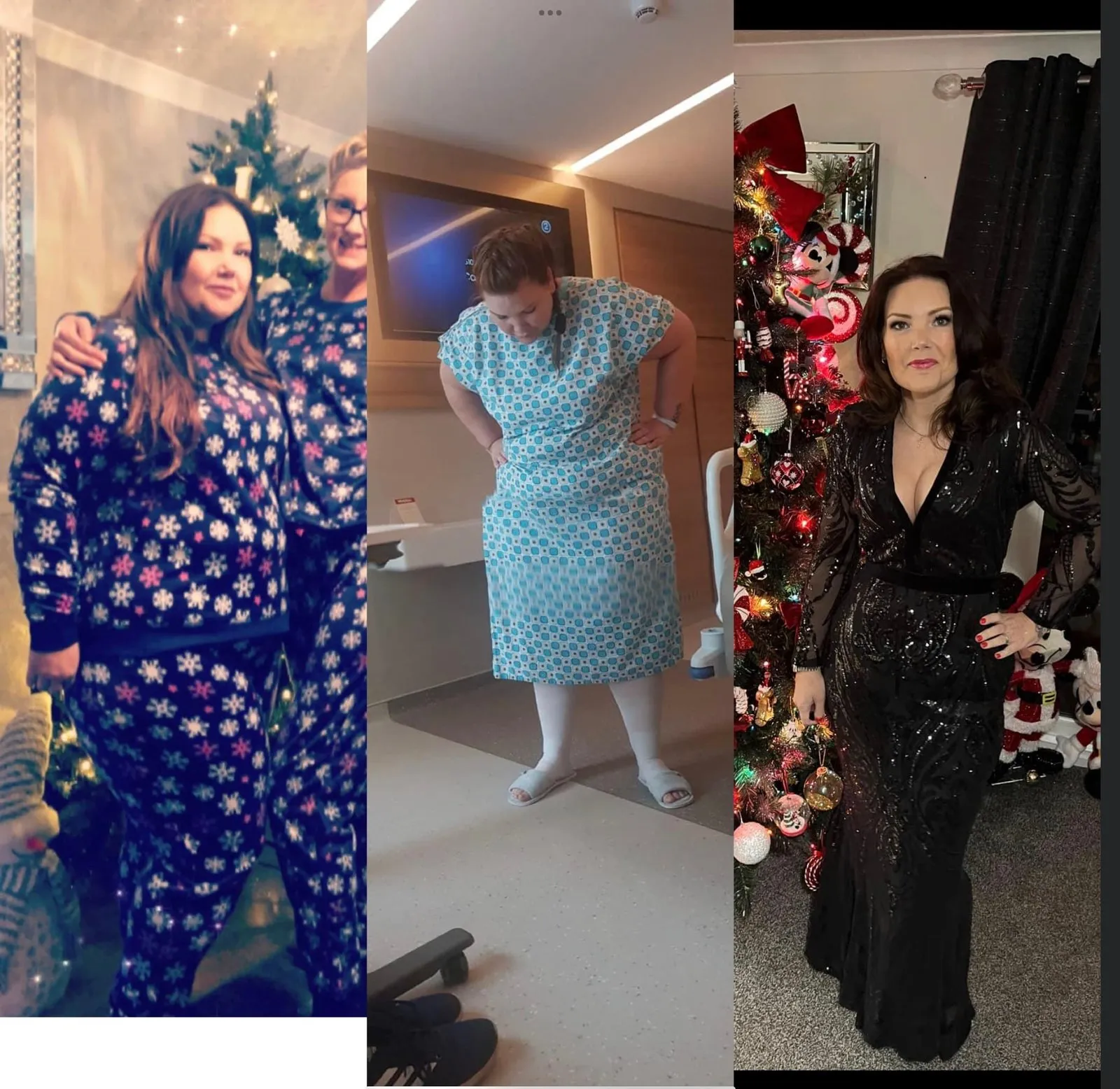 Weight loss surgery before and after transformation - patient 6