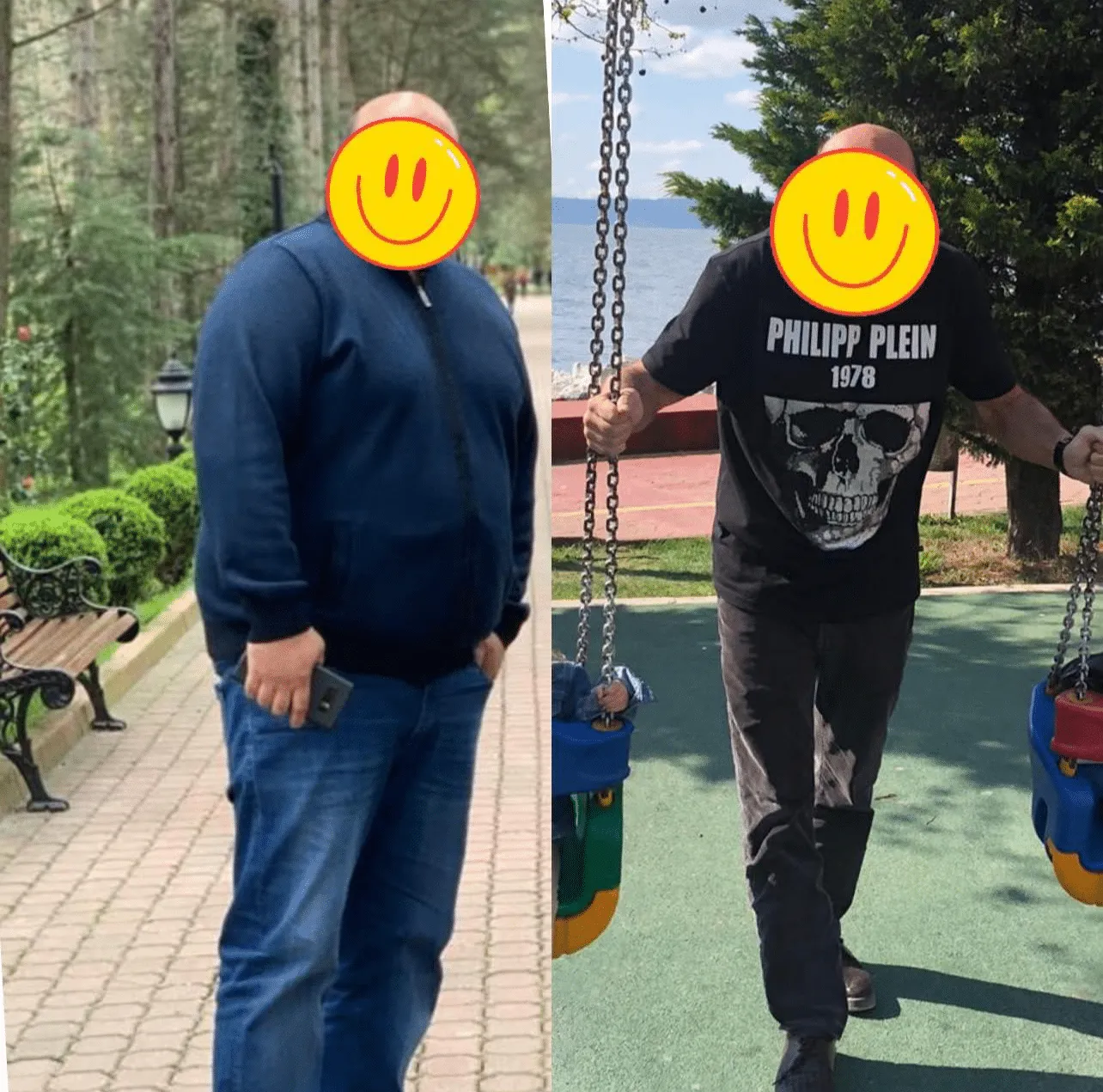 Weight loss surgery before and after transformation - patient 7