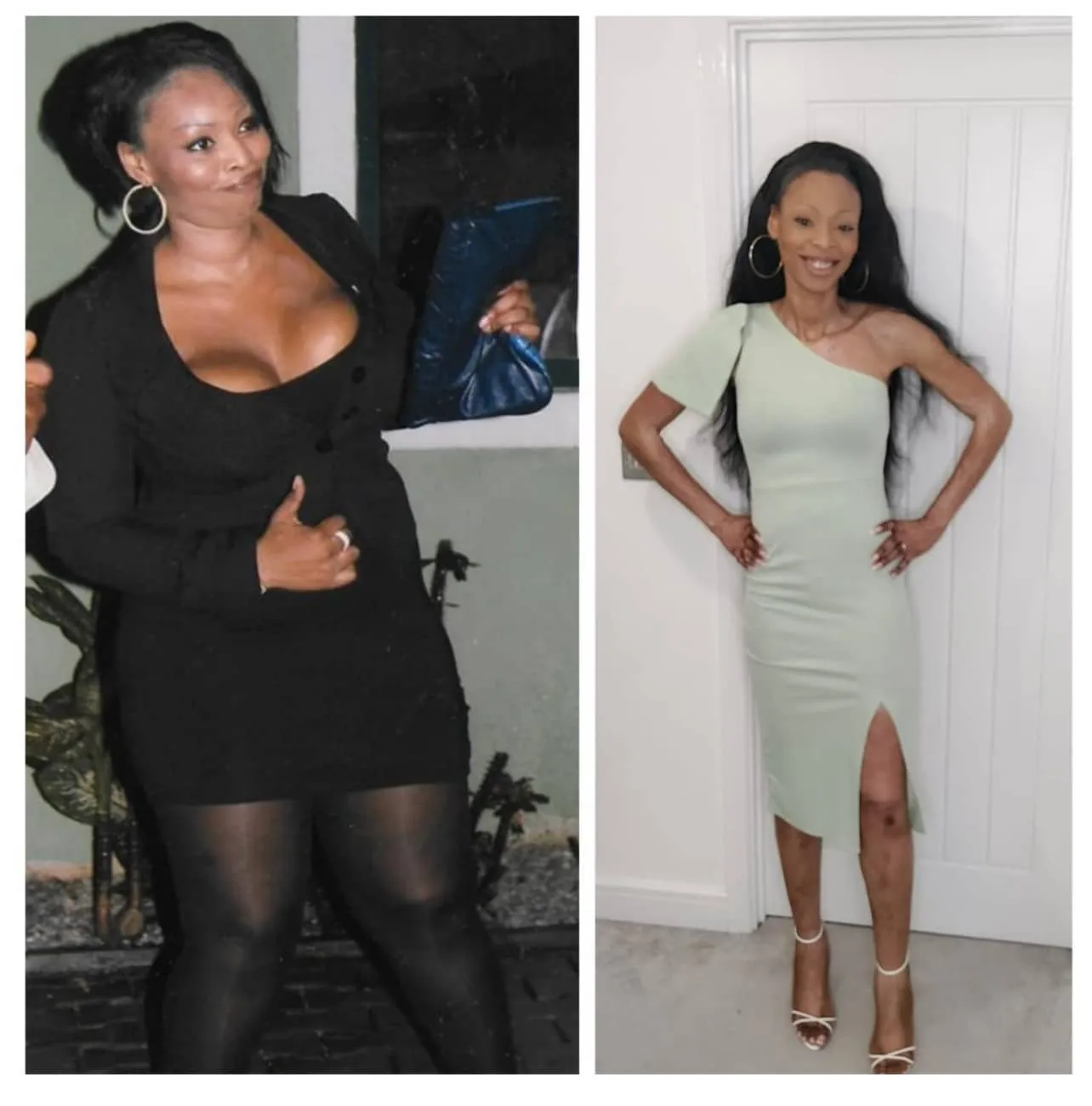 Weight loss surgery before and after transformation - patient 8
