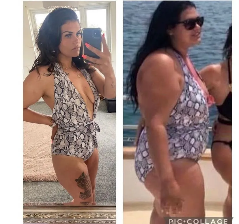 Weight loss surgery before and after transformation - patient 9