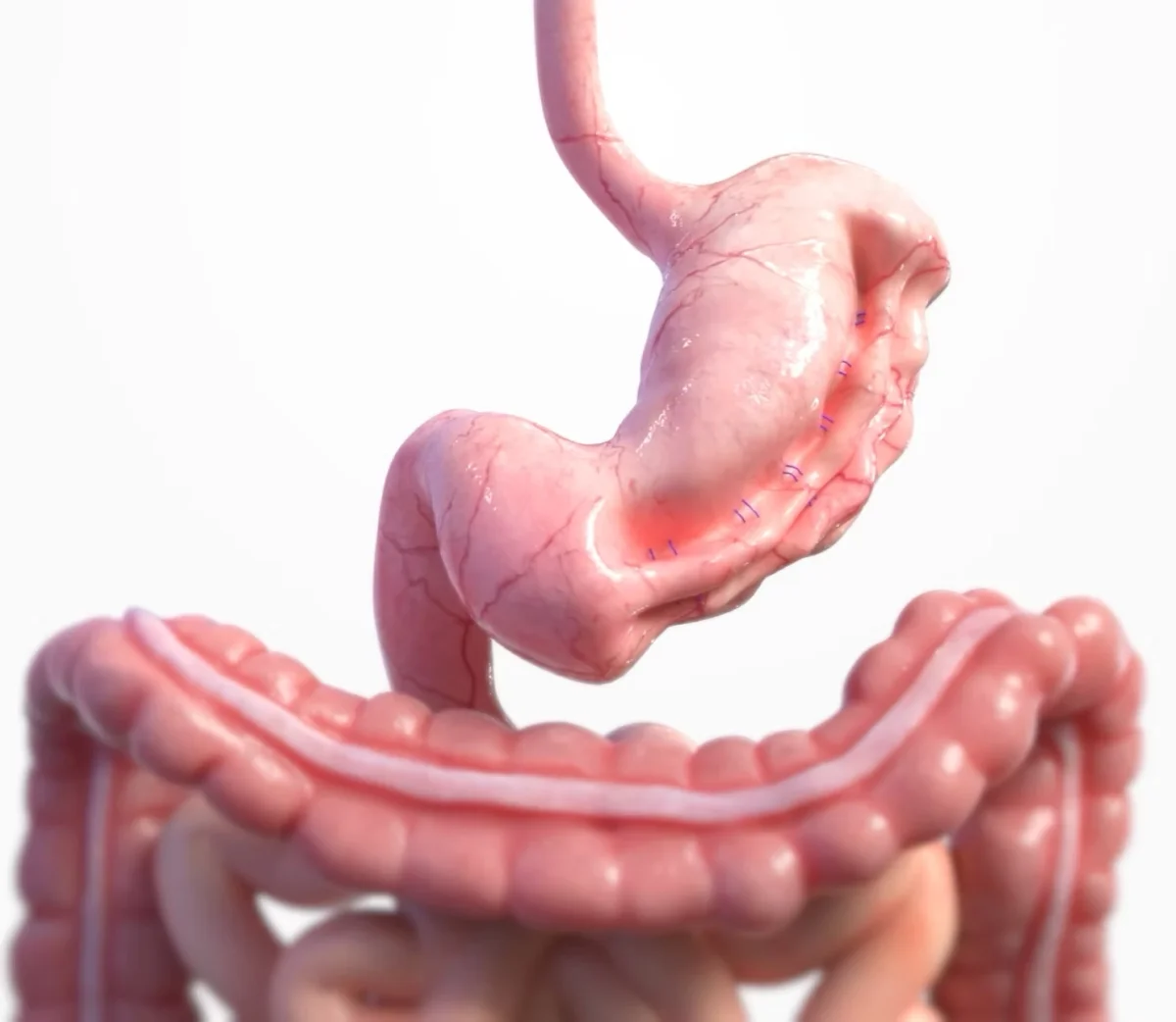 3D medical illustration of stomach after Endoscopic Sleeve Gastroplasty (ESG) showing the sutured tubular shape created without removing any tissue