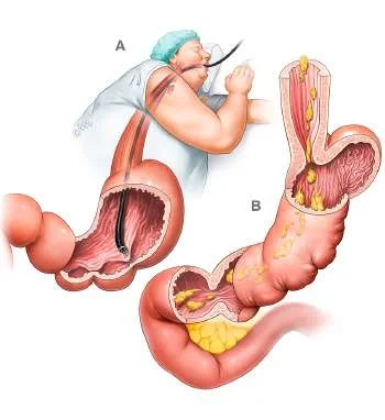 IFSO Atlas illustration of Endoscopic Sleeve Gastroplasty (ESG)