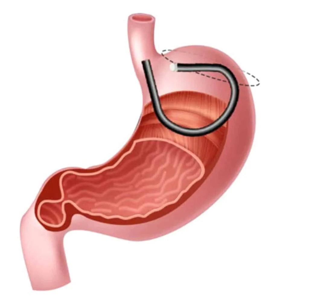 GFMA (Gastric Fundus Mucosal Ablation)