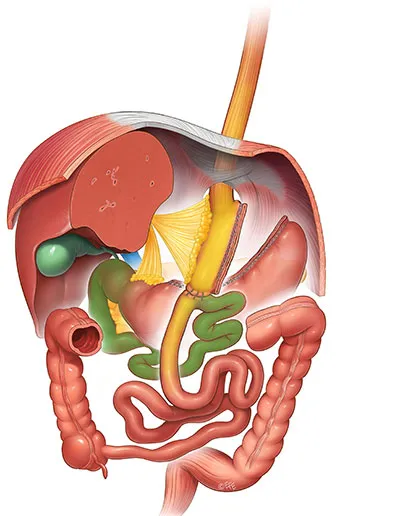 Mini Gastric Bypass Surgery Illustration