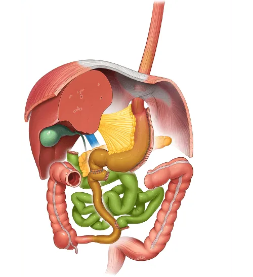 IFSO Atlas illustration of Duodenal Switch