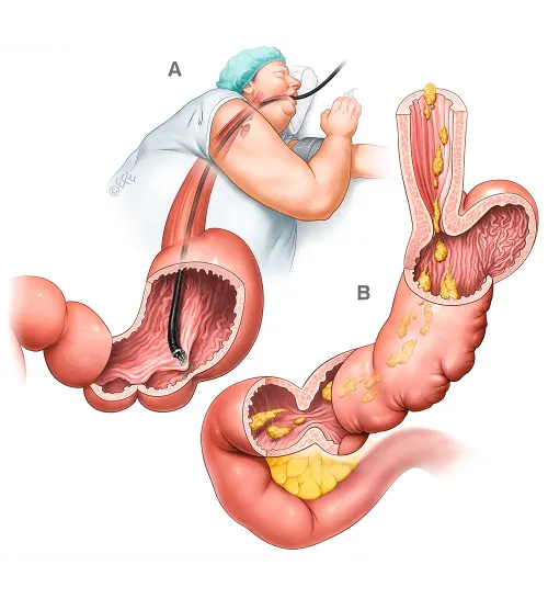 ESG (Endoscopic Sleeve Gastroplasty)