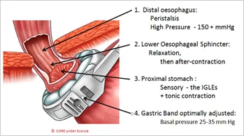 IFSO Atlas illustration of Adjustable Gastric Band