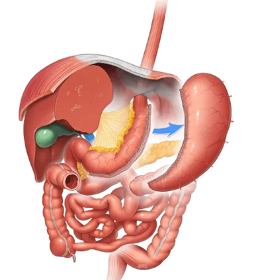 IFSO Atlas illustration of Gastric Sleeve Surgery