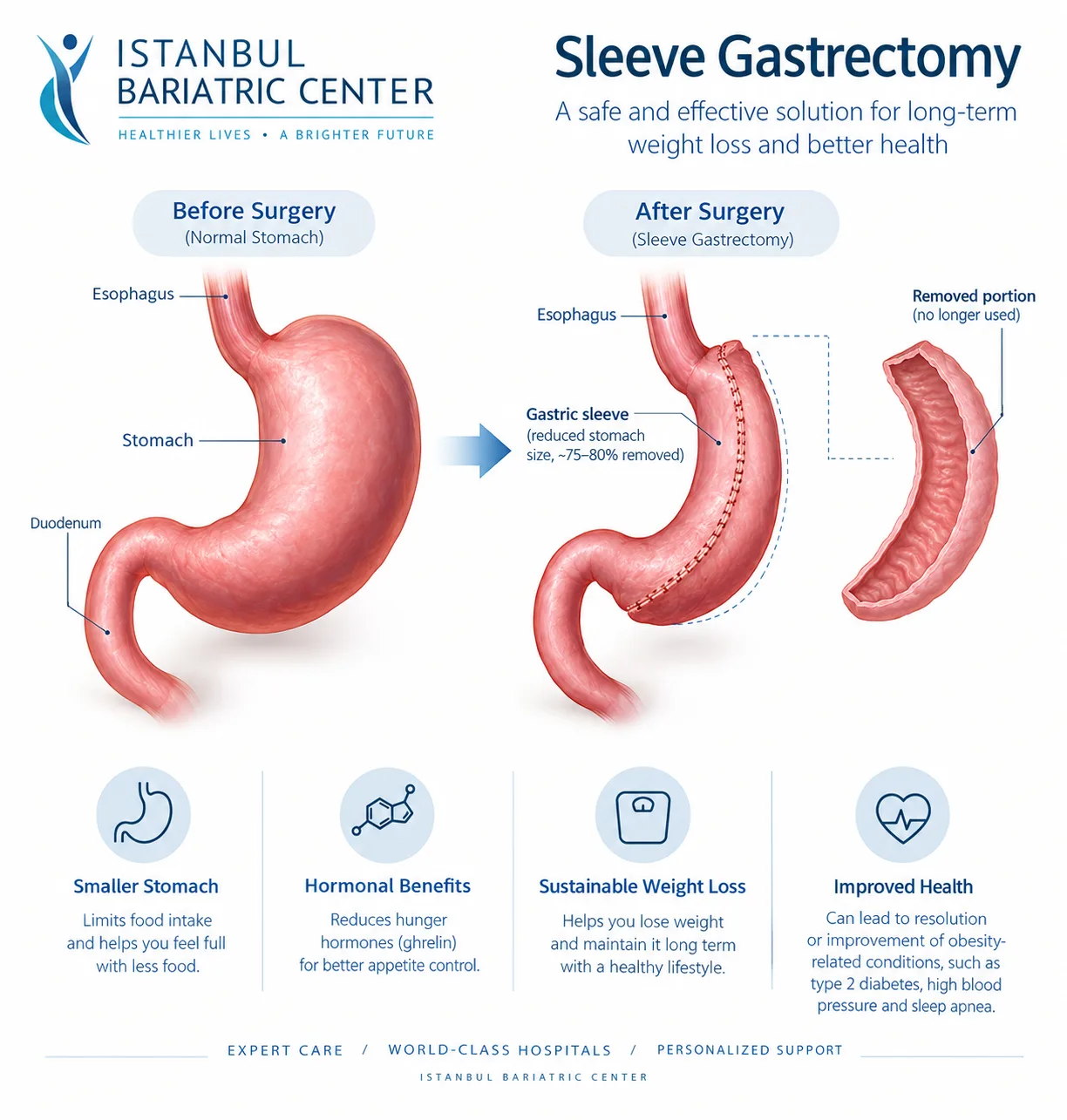 Diagram comparing the stomach before and after sleeve gastrectomy