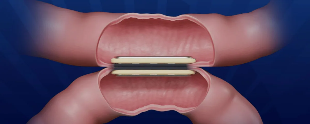 Illustration of two magnets creating compression between bowel segments