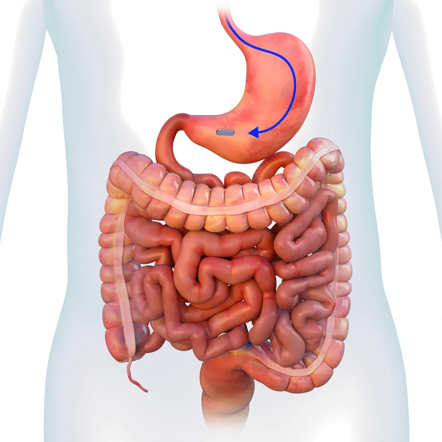 Supplied medical illustration of the magnetic duodeno-ileal approach