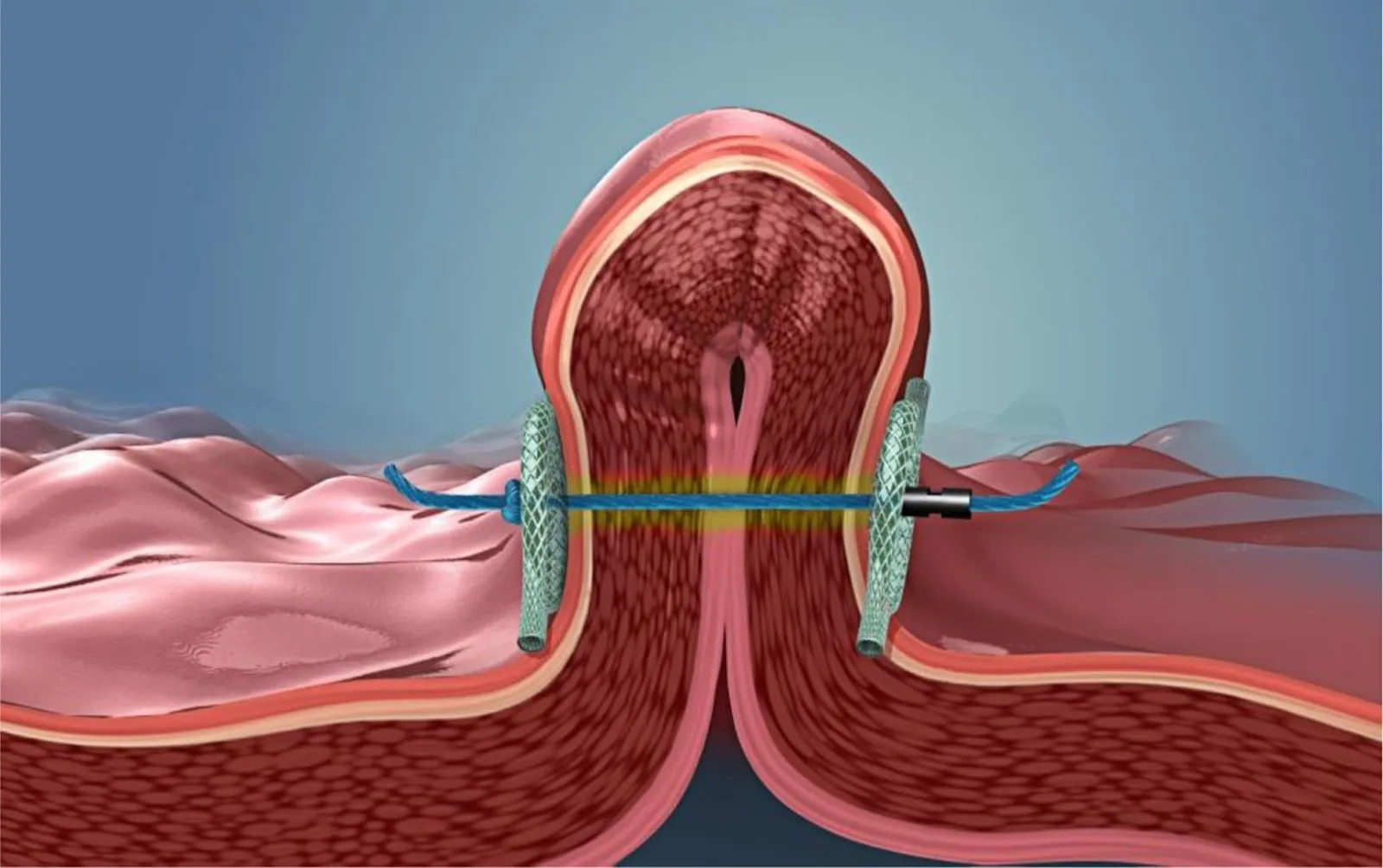 POSE-2 Double Helix: The Next Generation of Non-Surgical Weight Loss
