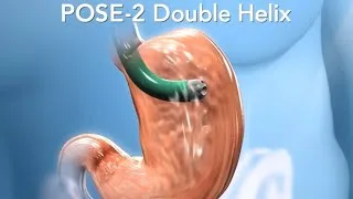 Illustration of POSE-2 Double Helix procedure