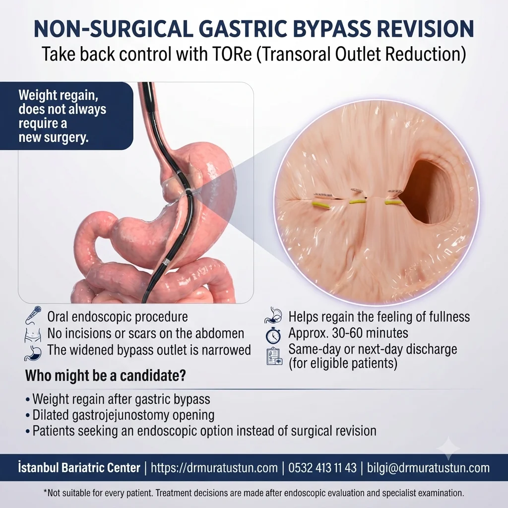 Non-surgical gastric bypass revision with TORe (Transoral Outlet Reduction) infographic: oral endoscopic procedure, no incisions, narrowed bypass outlet, 30-60 minutes, same-day discharge, candidates with weight regain and dilated gastrojejunostomy