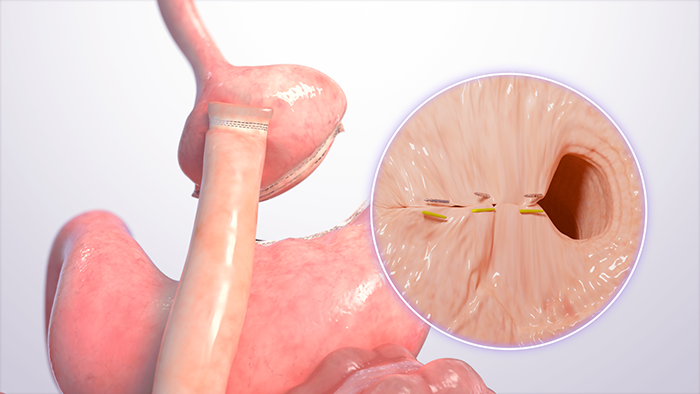TORe (Transoral Outlet Reduction)