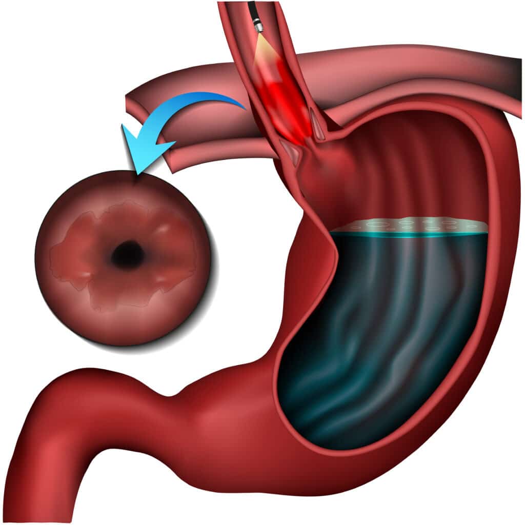 Barrett Esophagus